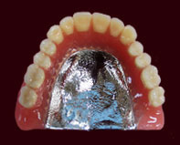 金属床（チタン）義歯